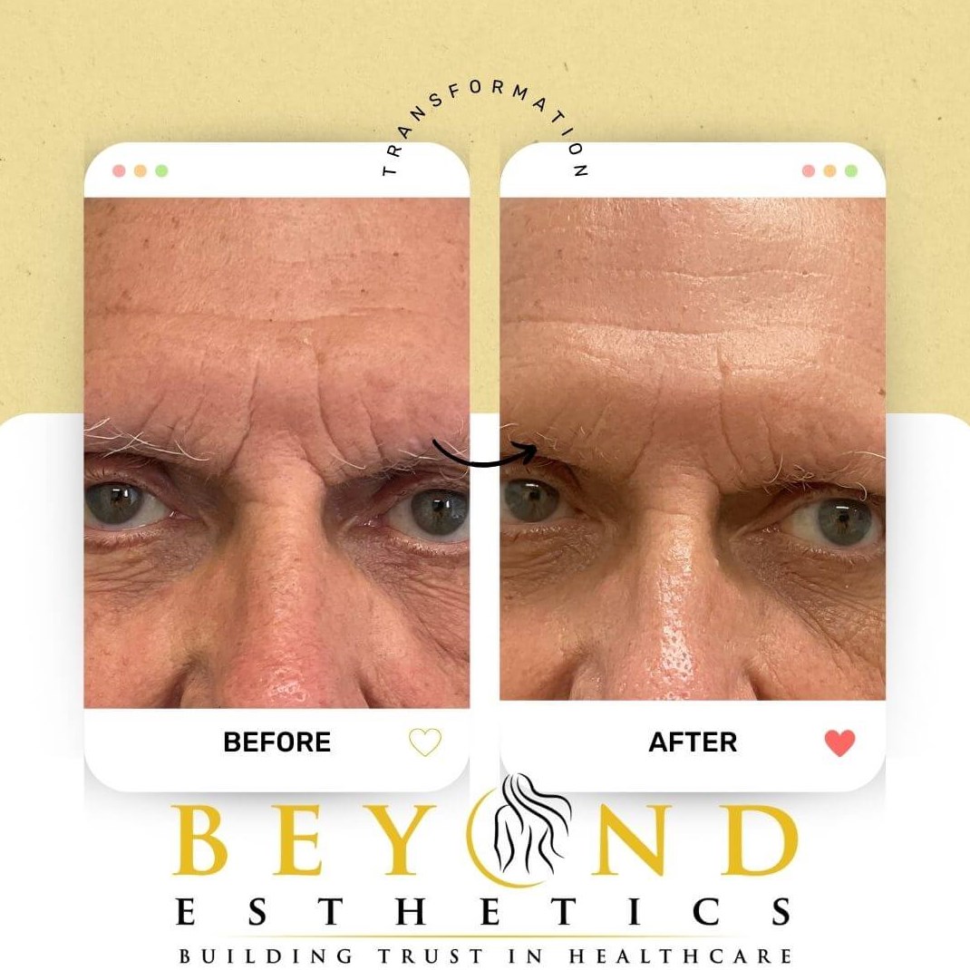 Opus Plasma Resurfacing - 2 Tr